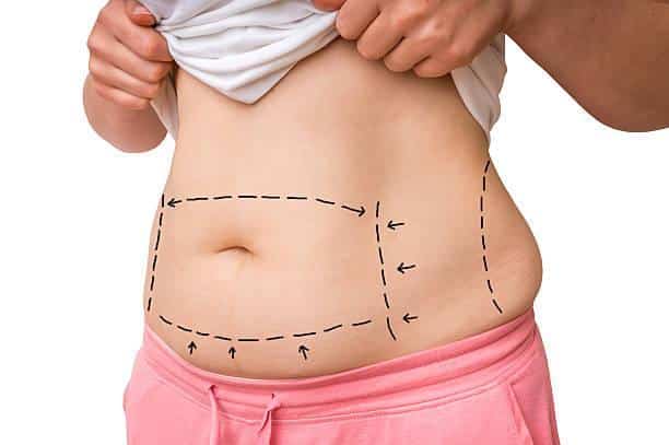 Image 1 of Liposuction In Riyadh Consultation Essentials: Questions to Ask Experts