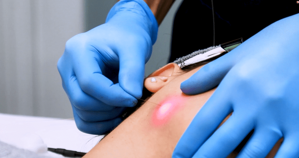 Image 1 of Endolift in Dubai: Skin Tightening Without Surgery