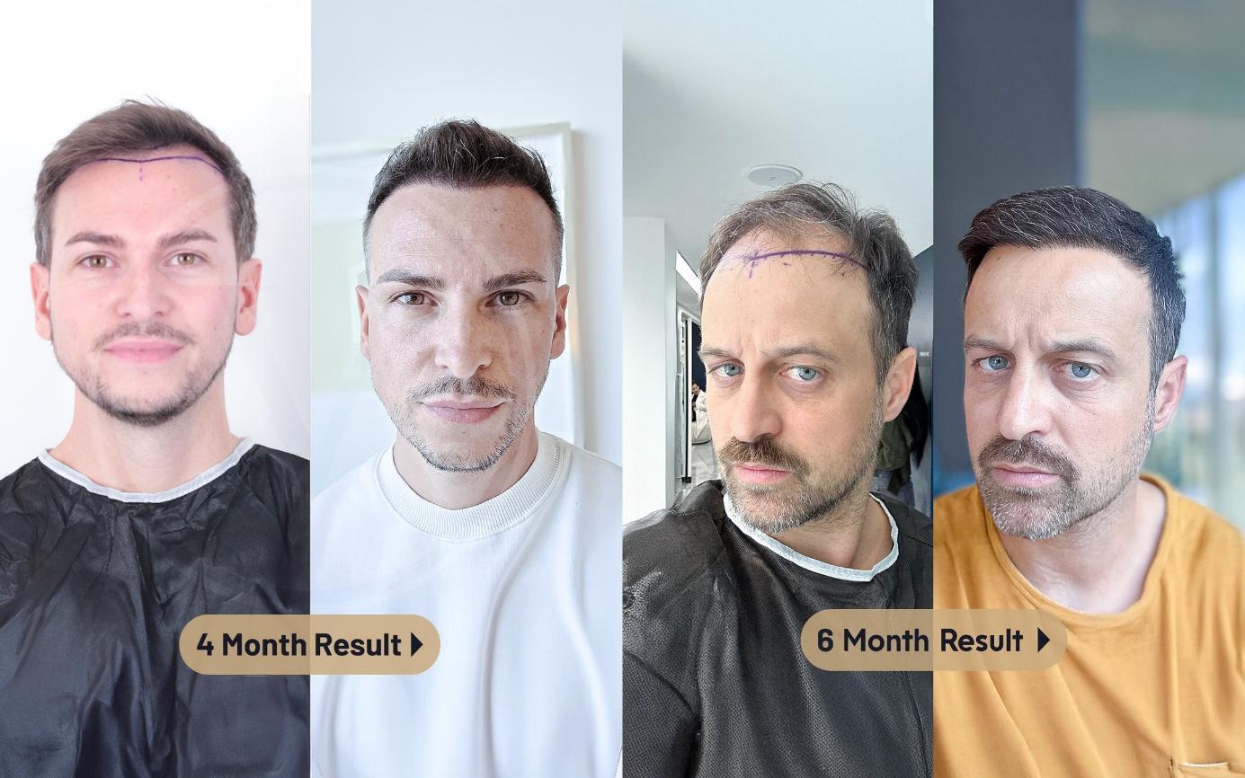 Image 1 of Istanbul Vita and the New Era of Hair Transplant Planning