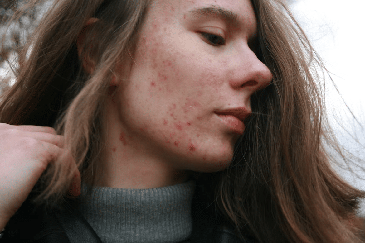 Image 1 of Acne in Adulthood: Why It Doesn’t Always Go Away