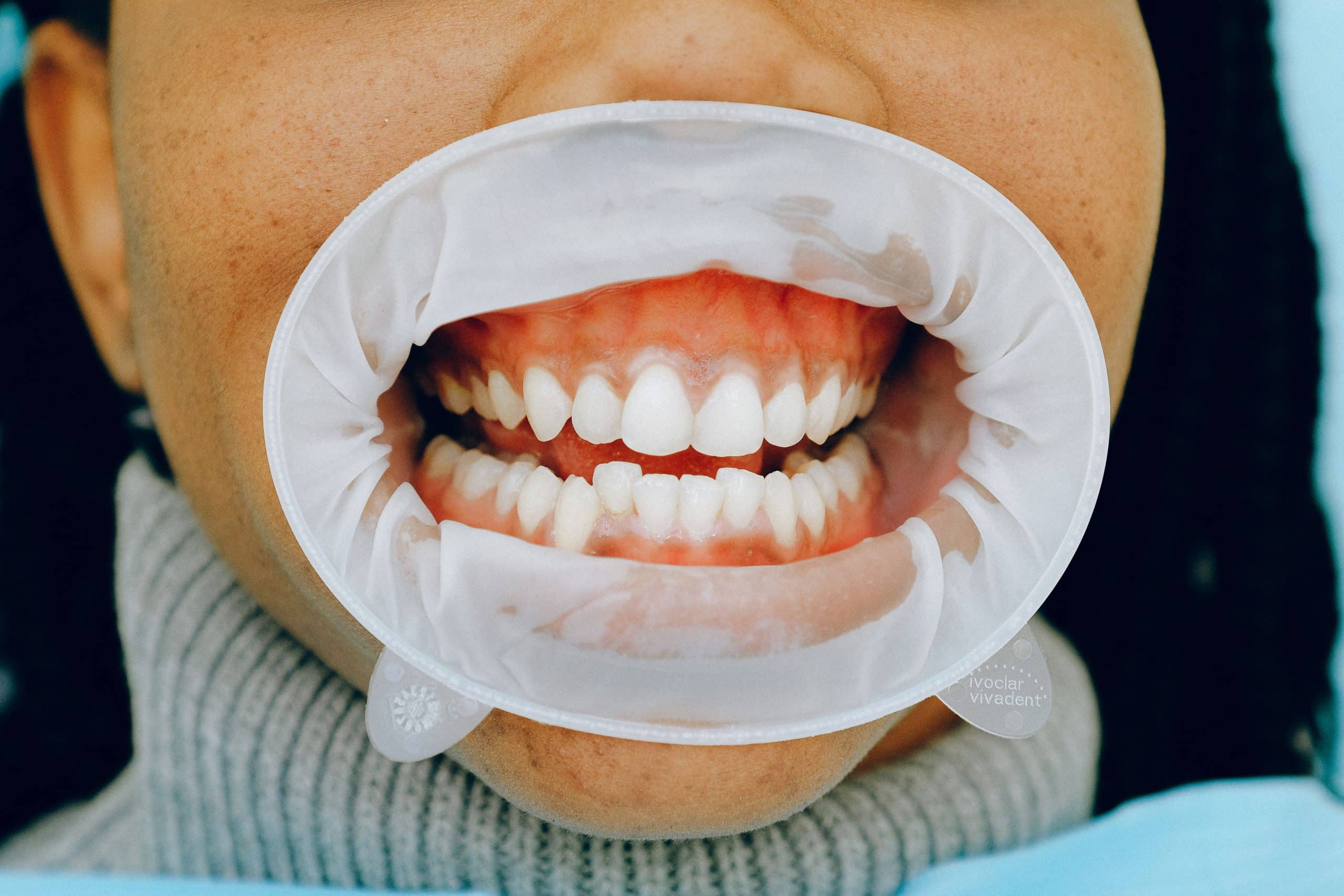 How Nutrition Affects Your Teeth and Gums