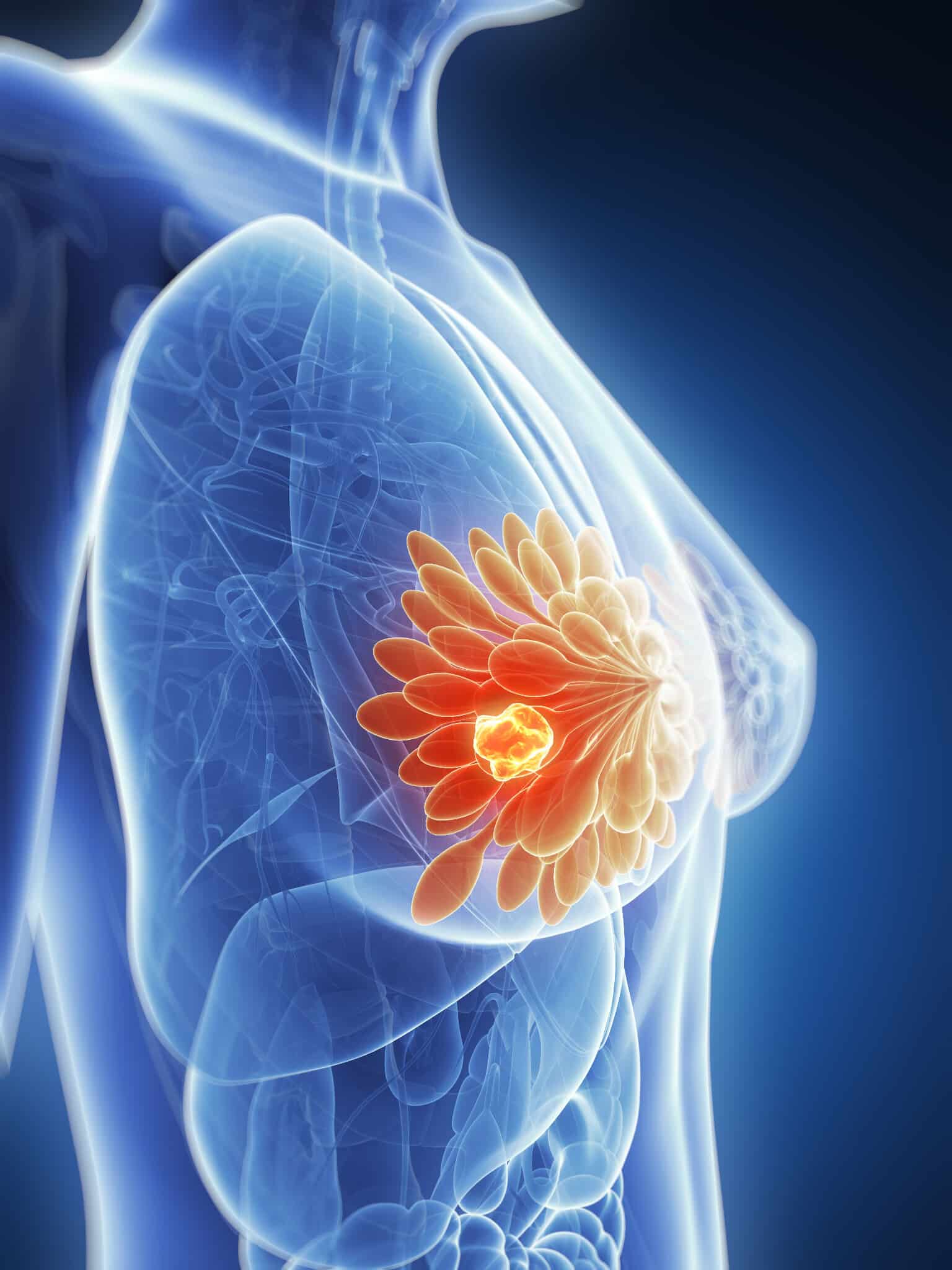 Image 1 of While the idea of a mastectomy may be daunting in the beginning, most patients take comfort in knowing that it can remove their cancer and lessen the chances of recurrence.